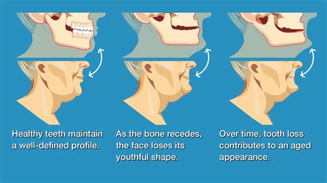 Does removing tongue negates the negative effects of abrasive.